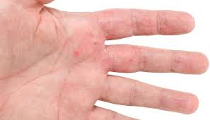 Hand eczema 
